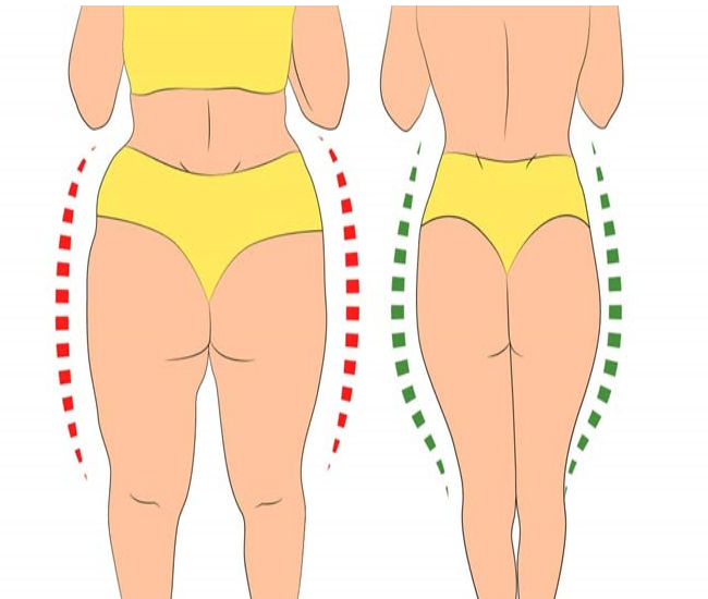 جراحی باسن و انواع روش های آن